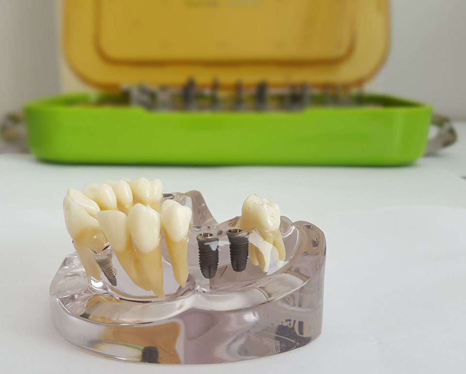 Implantat Nobel Biocare